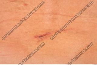 human skin scars 0004